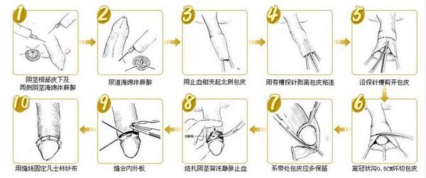 包茎手术拆线照片图片