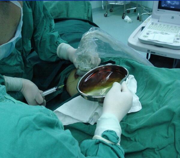 超声引导麻醉,定位 腔镜在小切口乳腺肿块切除中的应用1