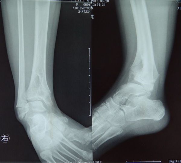 什么是先天性胫骨弯曲症-典型病例