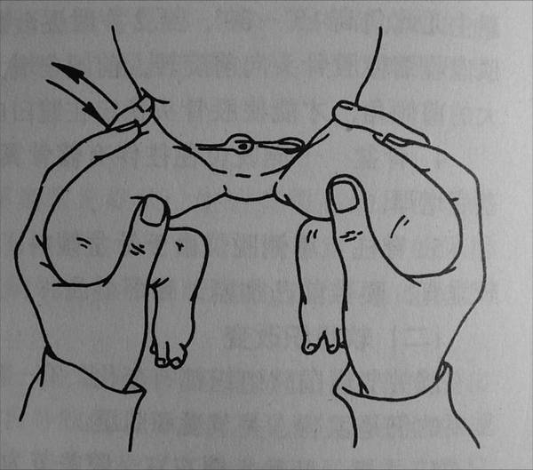 ddh(先髋/发育性髋关节脱位)做操手法示意图