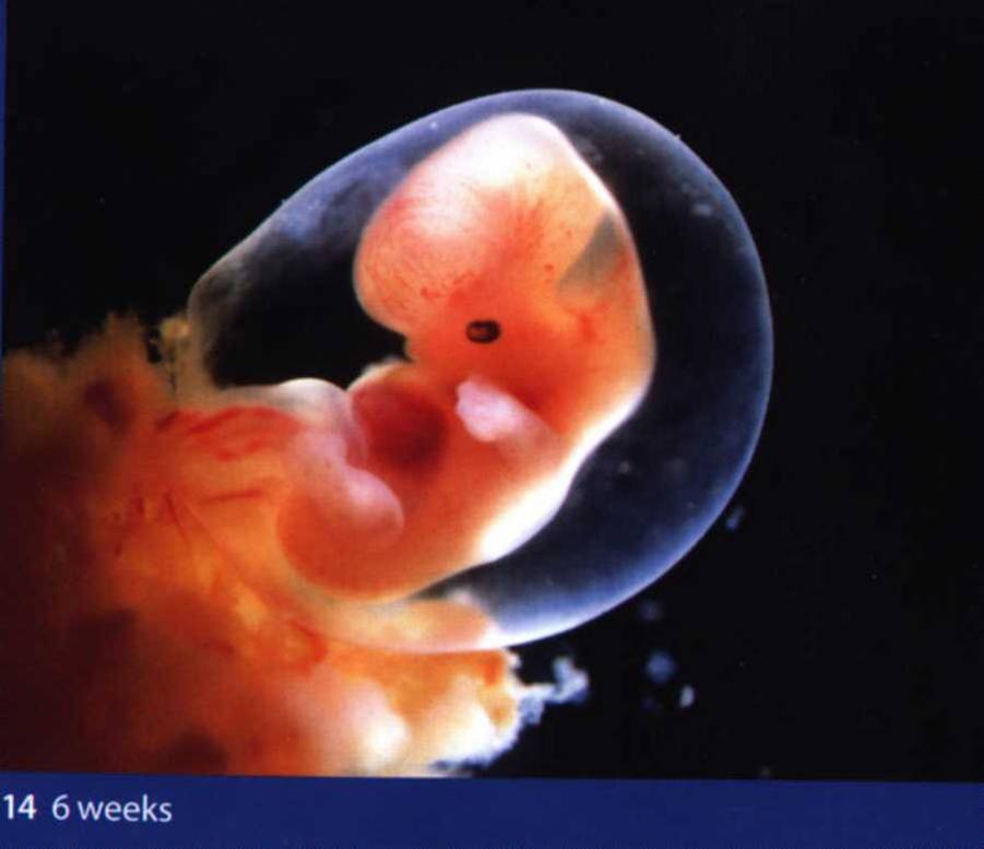 宫外孕胚胎图片