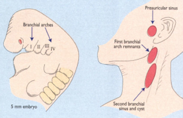 鳃裂遗迹 branchial cleft remnant