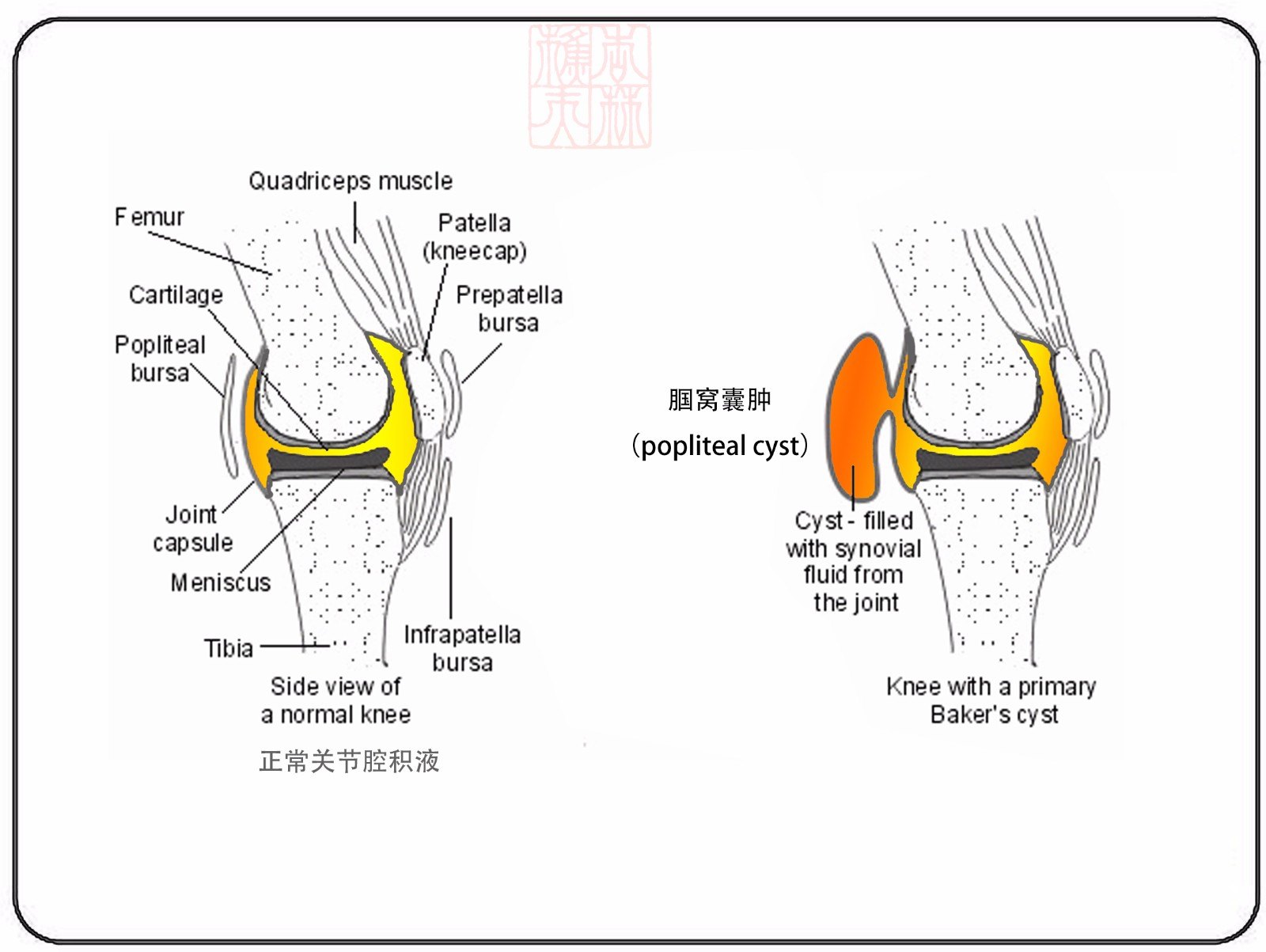 膝关节腘窝处小籽骨图片