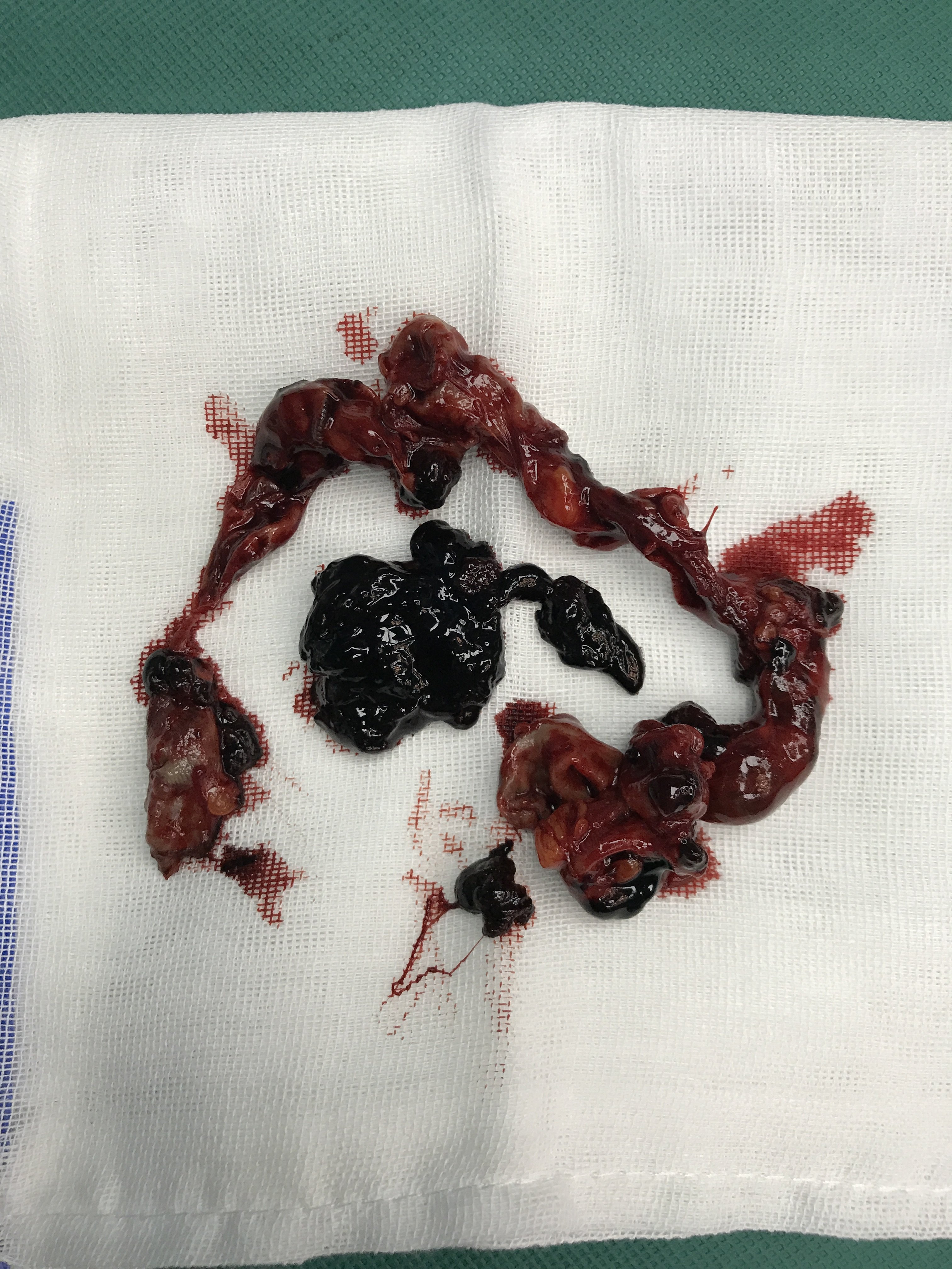 中发现鼓起来的"包包"里蕴藏的大量的血栓,验证了之前的诊断,见下图:?