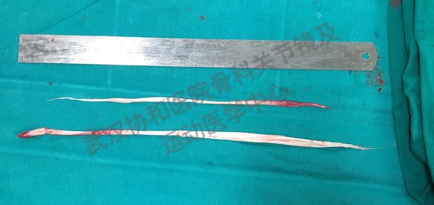 3)编织缝合制备肌腱移植物并测量直径(一般直径至少达到7