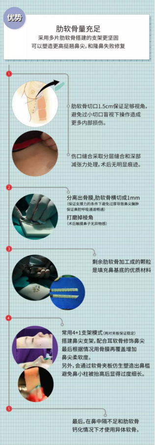 巫文云解读 肋软骨隆鼻 隆鼻 手术 巫文云解读 肋软骨隆鼻 隆鼻 手术