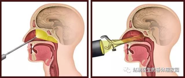 经鼻腔.jpeg
