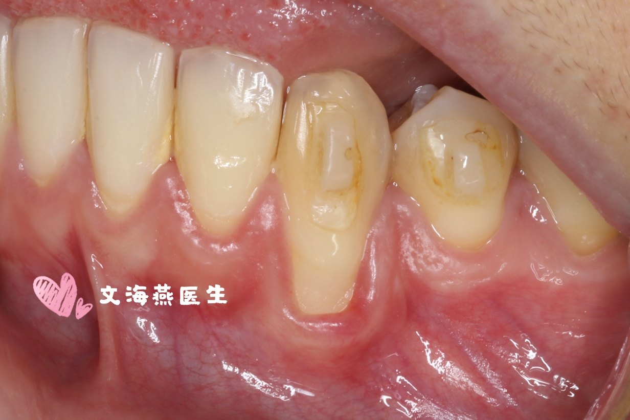 牙龈退缩治疗案例