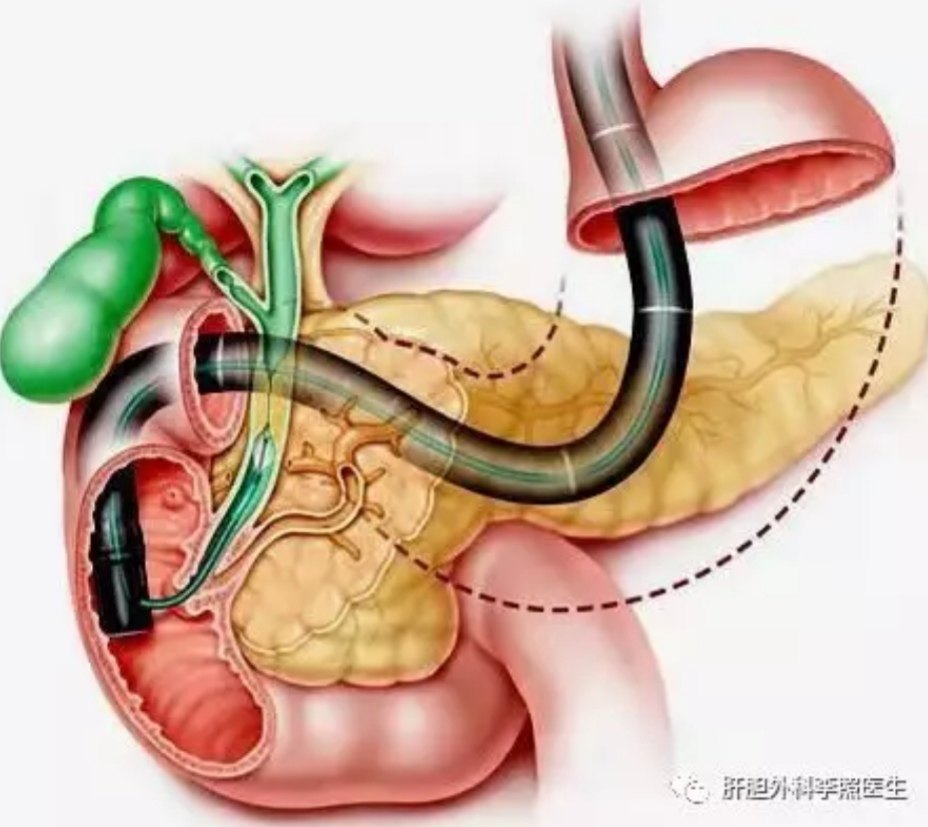 膽囊切除後是不是就沒膽了術後一個月疼得不敢吃東西