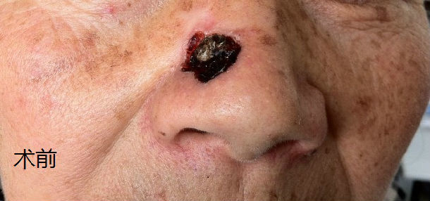 鼻部皮肤基底细胞癌治疗过程