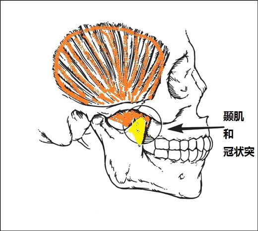 cm),通过切口显露颞肌腱和下颌骨冠状突 切断下颌骨冠状突1cm骨质,最