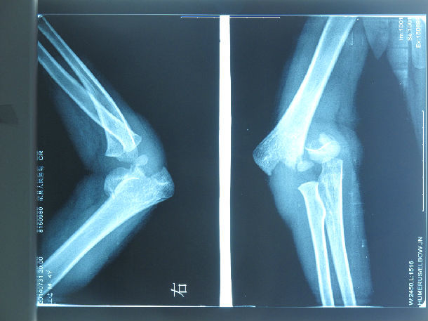 术前右肘关节正侧位片有肱骨髁上骨折切开复位术后 正位片术后侧位片