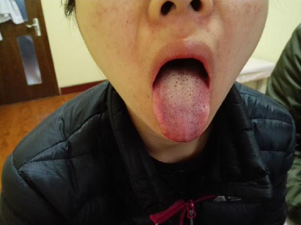 中医望诊展示——舌诊 - 好大夫在线