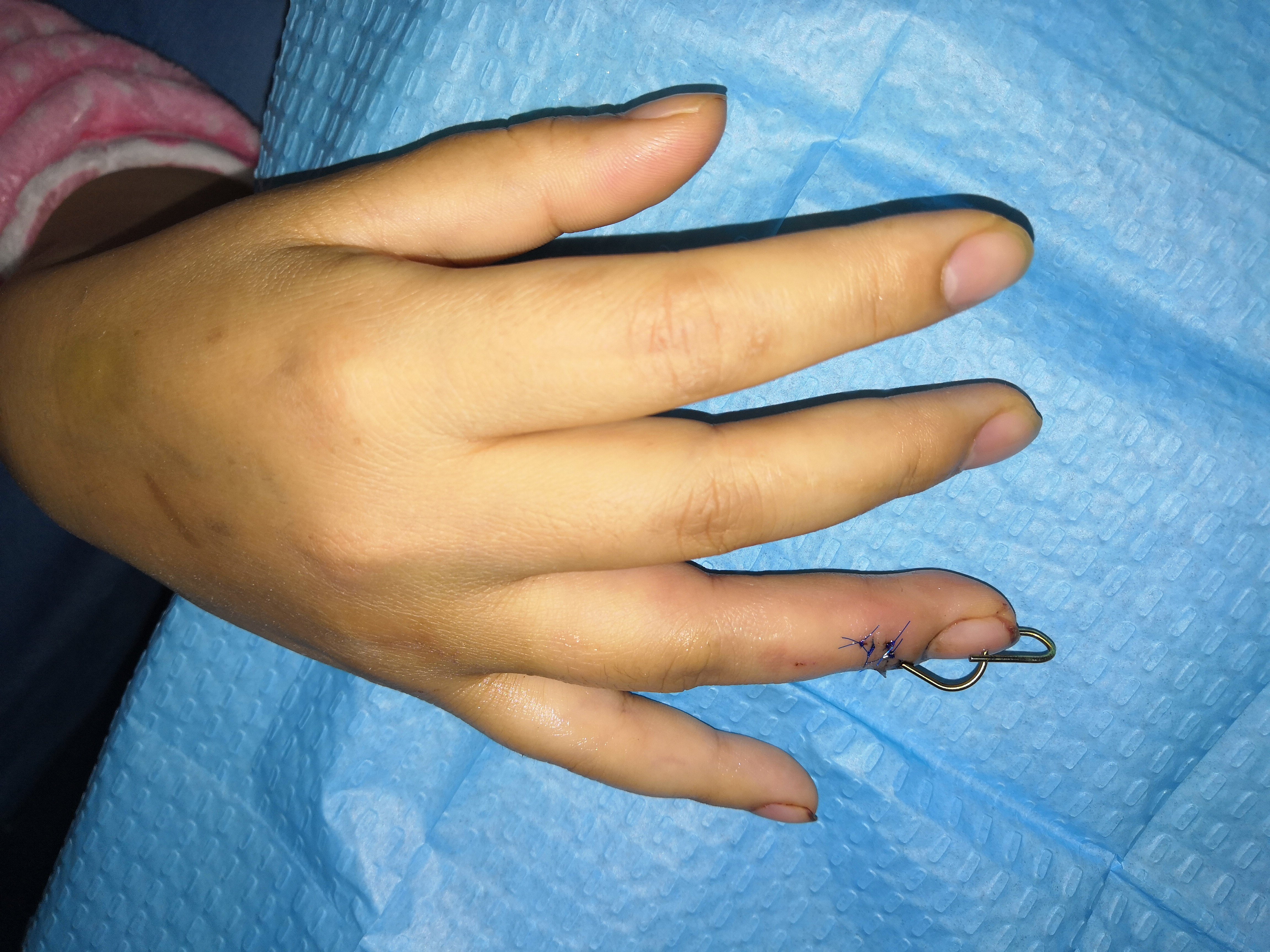 伴骨折的锤状指改良微创背侧阻挡钉技术