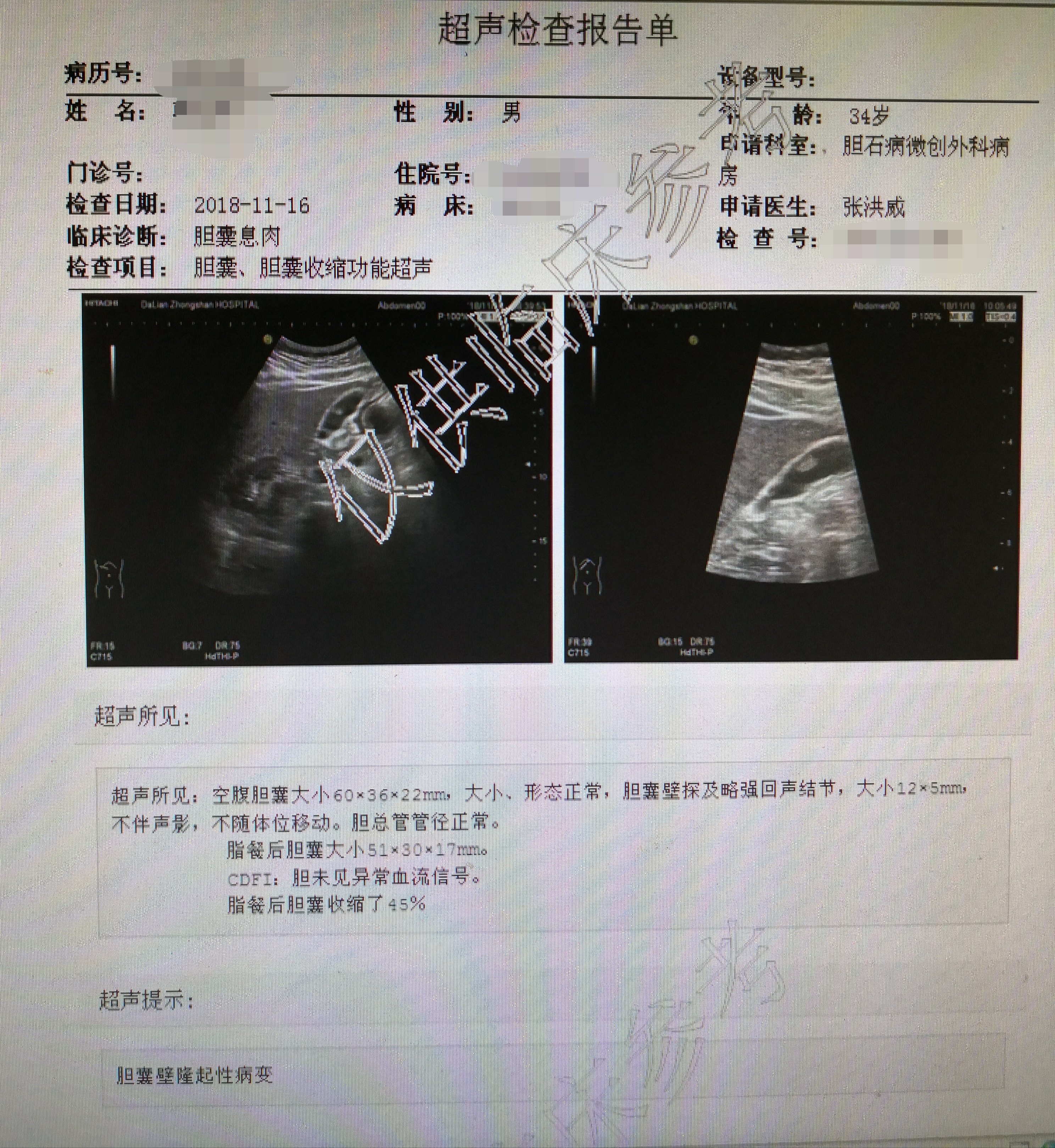 保胆取息肉术微创治疗胆囊良性息肉