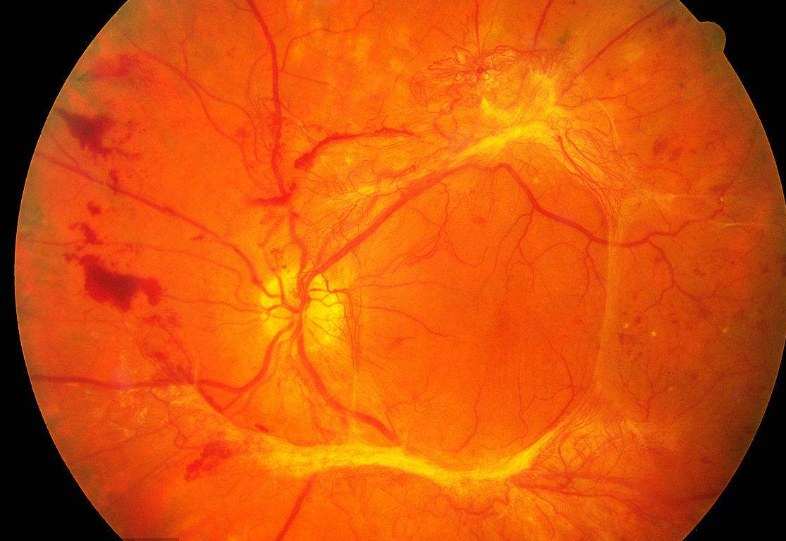 糖尿病性视网膜病变,一点感悟 - 好大夫在线