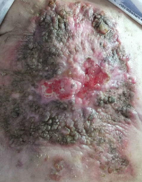 乳腺癌皮肤变化图片图片