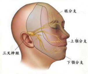 三叉神经痛是什么导致的?