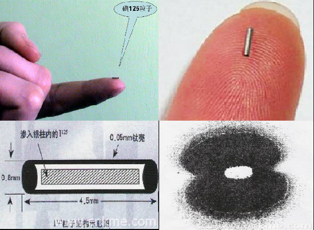 125i放射粒子简介及优势 - 好大夫在线