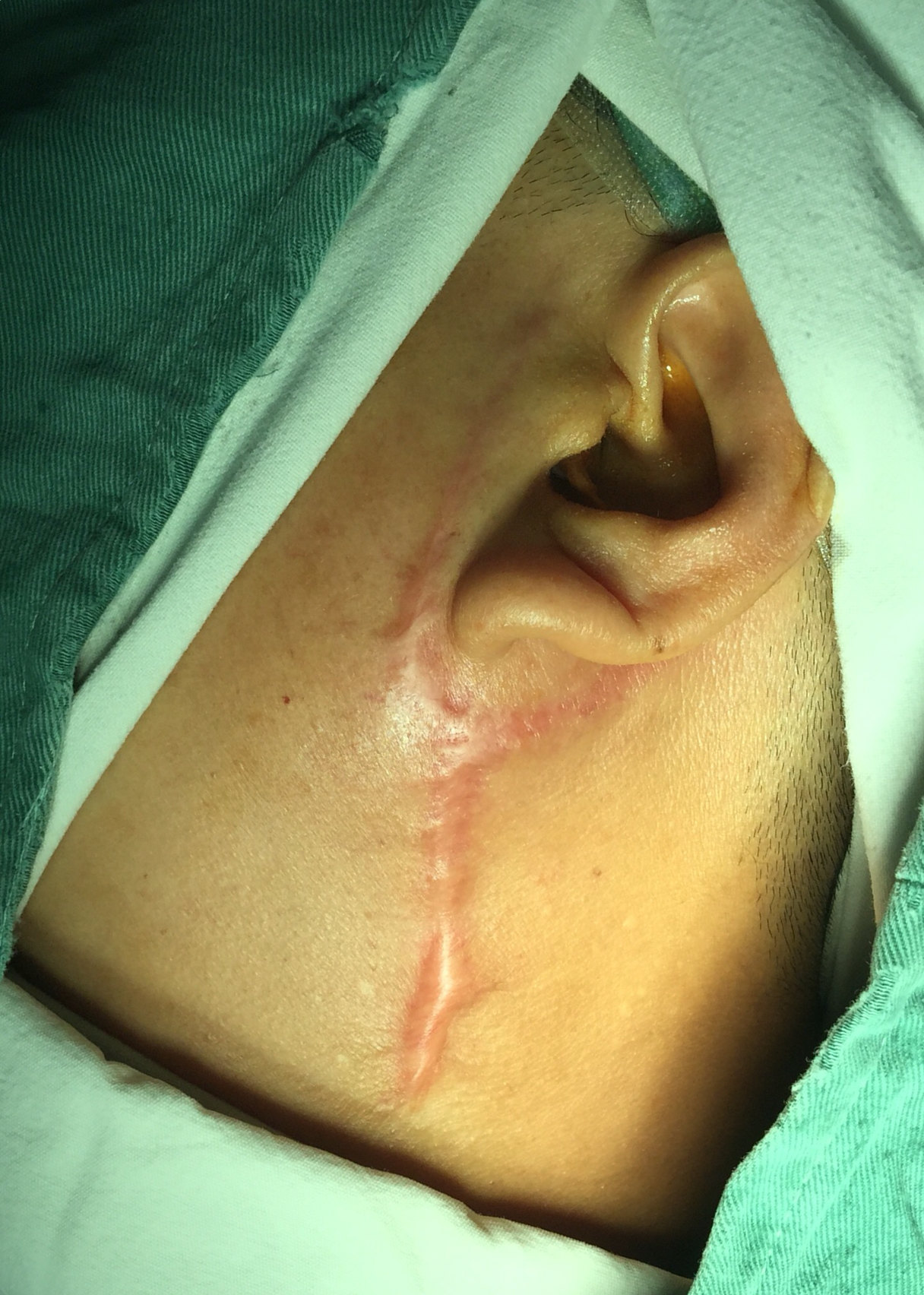 腮腺肿瘤手术疤痕图片图片