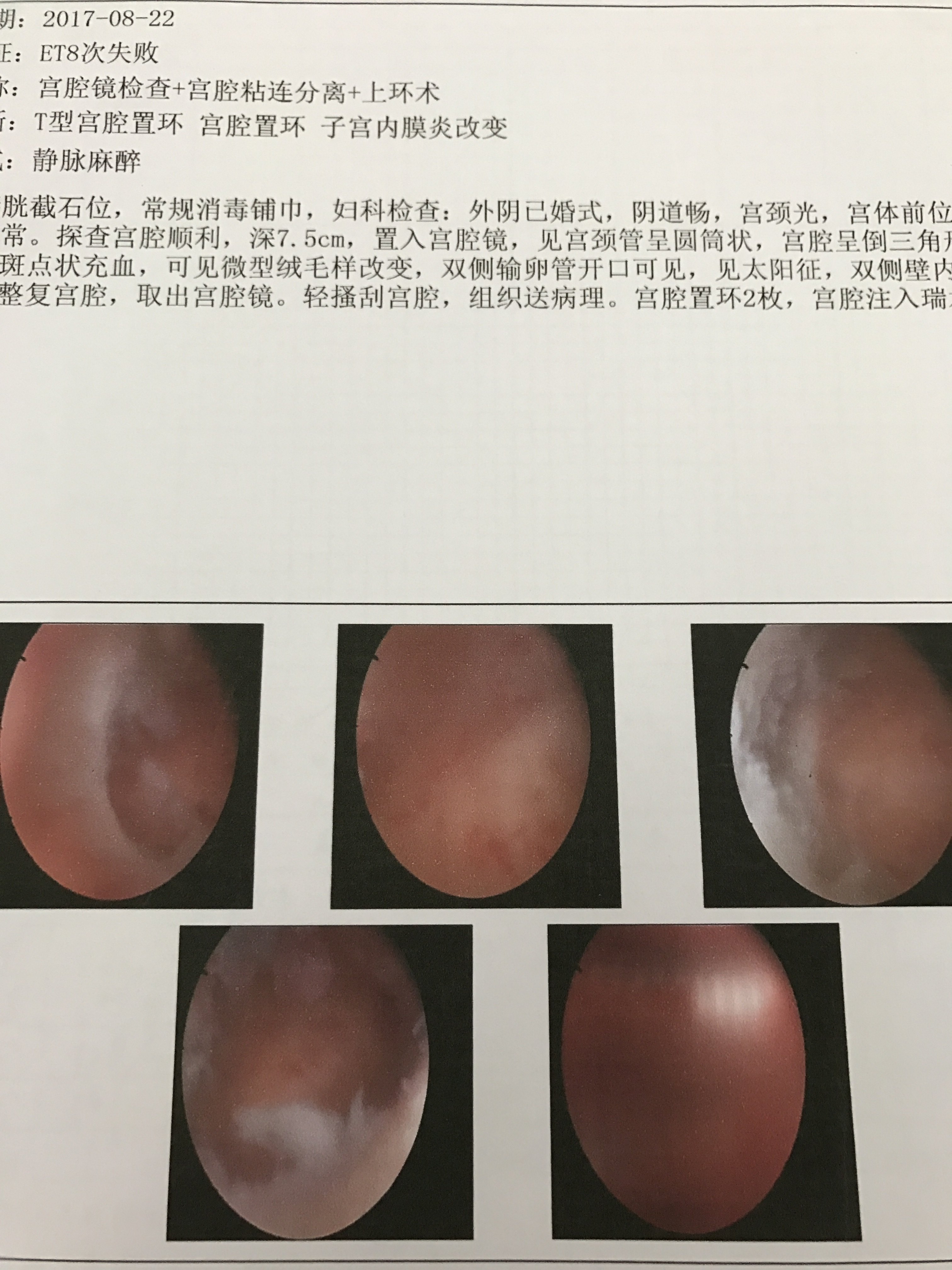 楼医生宫腔镜手术案例一