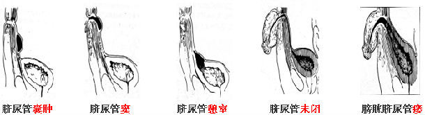 脐尿管囊肿手术步骤图片