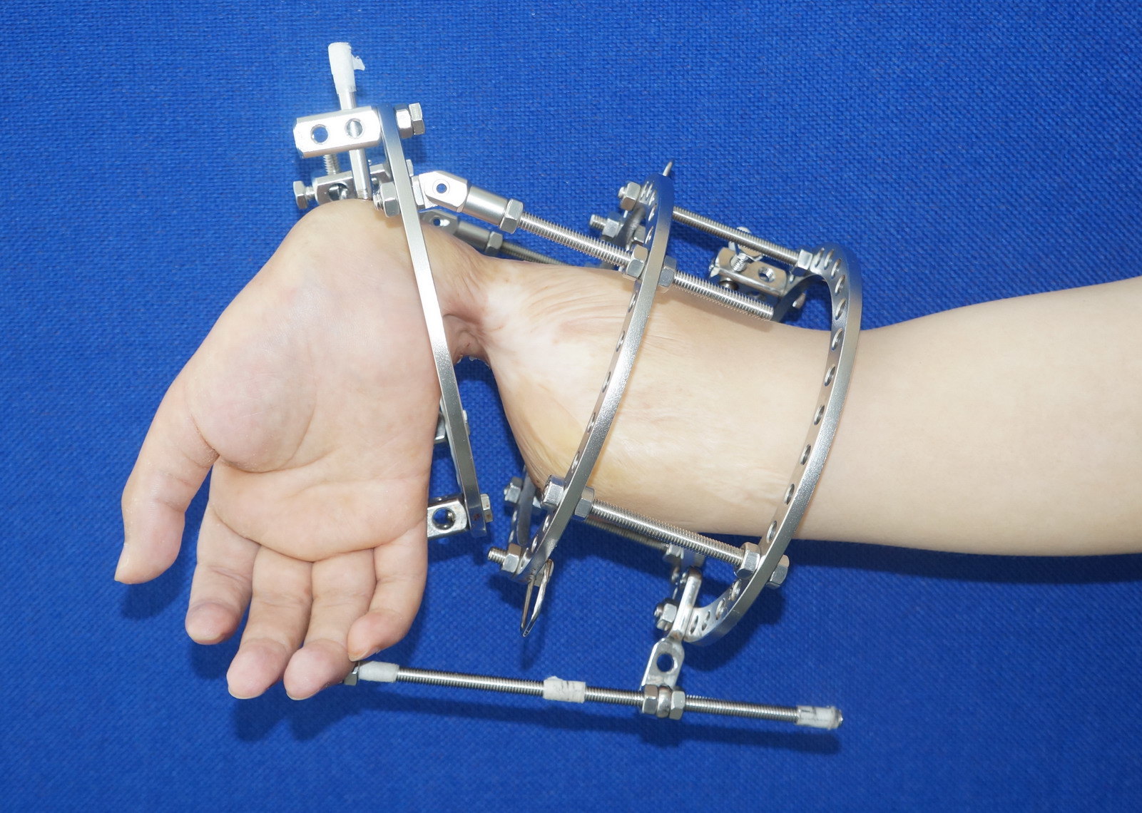 图2术前x片图1术前外观