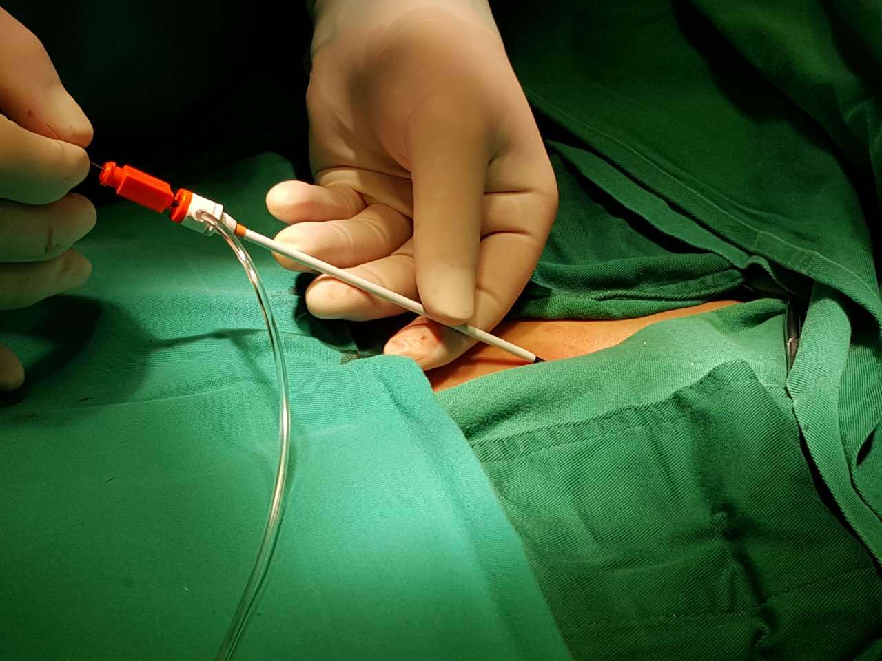 不开刀,不吃线——超声引导经皮介入技术治疗房间隔缺损