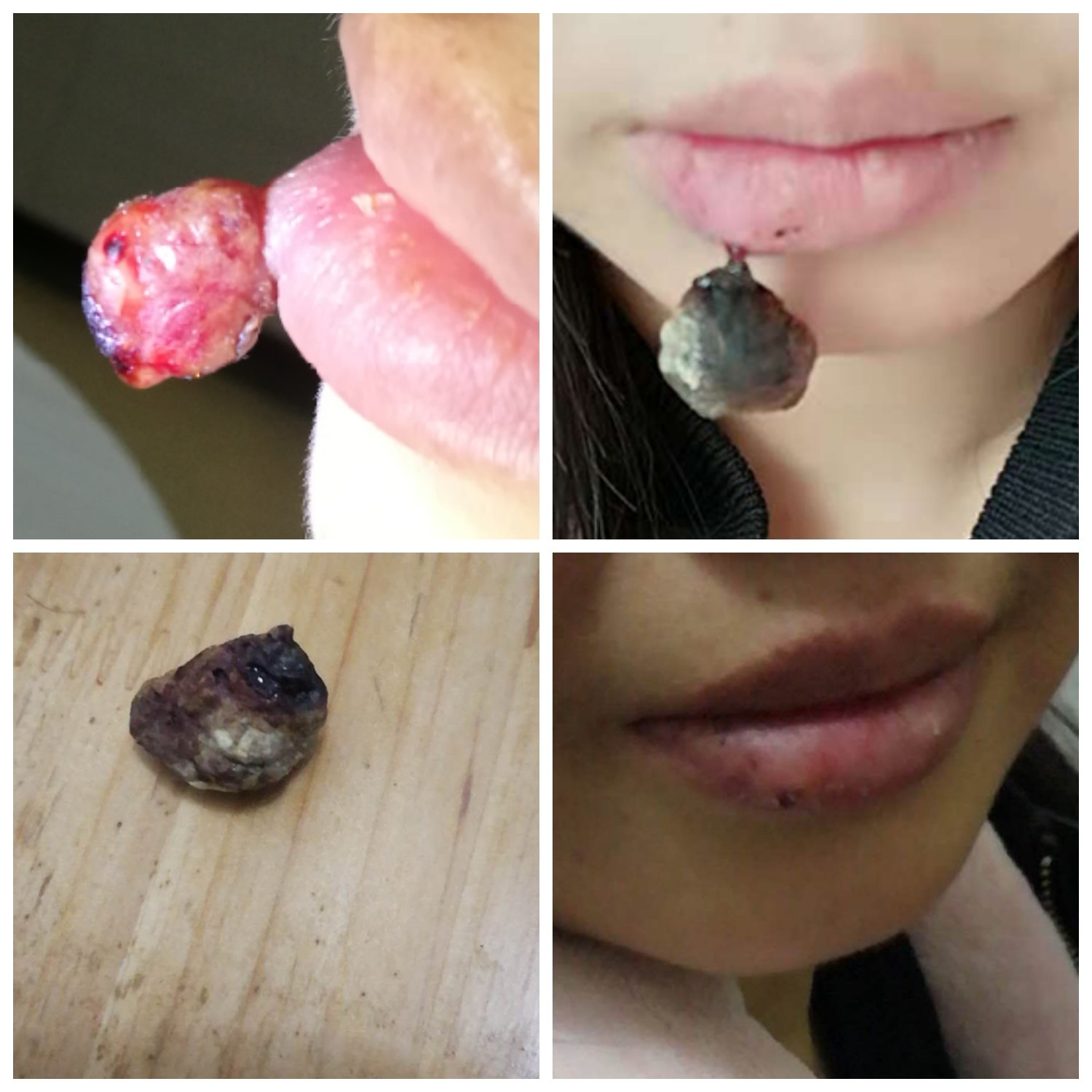 嘴唇化脓性肉芽肿图片