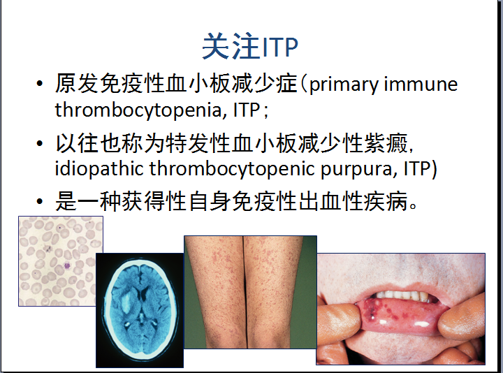 原发免疫性血小板减少症2016中国专家共识思考 