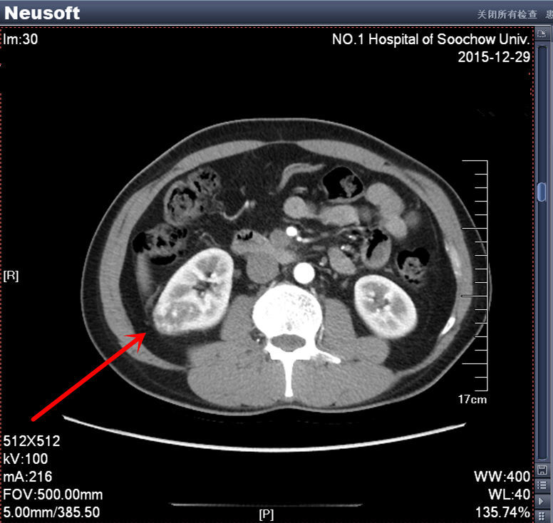 術前增強ct高度懷疑腎癌病例一 2016年01月手術患者,男,41歲,河南人