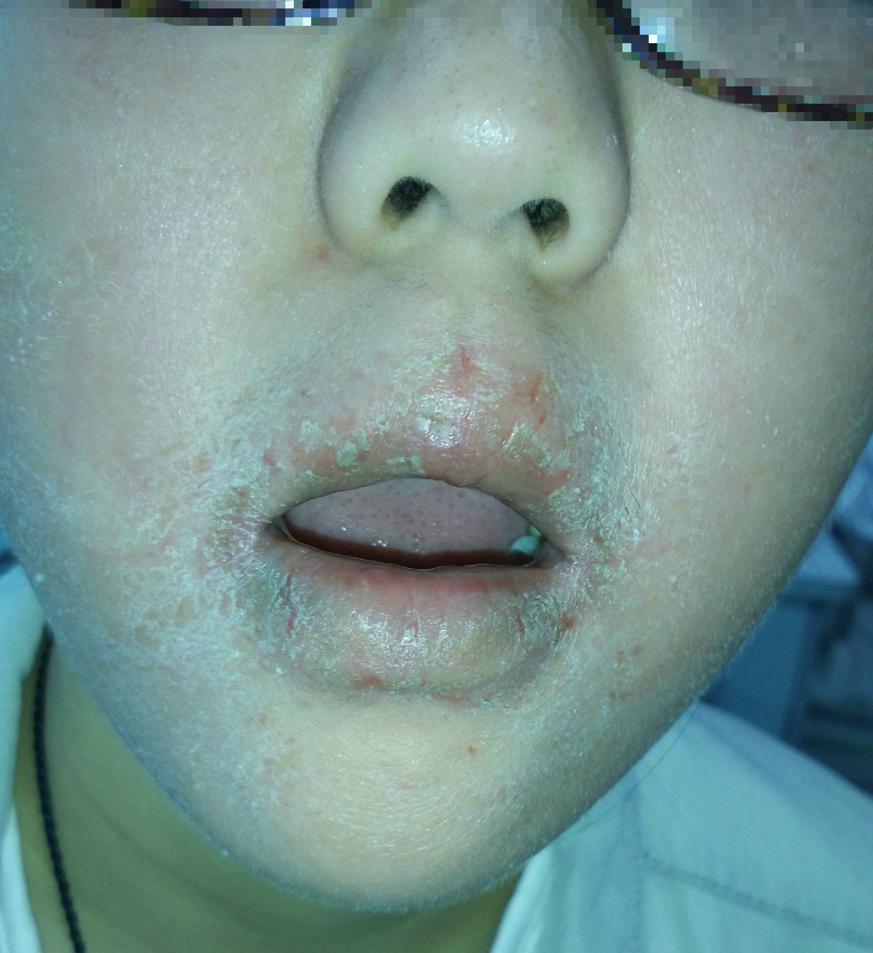 唇炎病案 - 好大夫在线