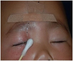 如何治疗慢性泪囊炎