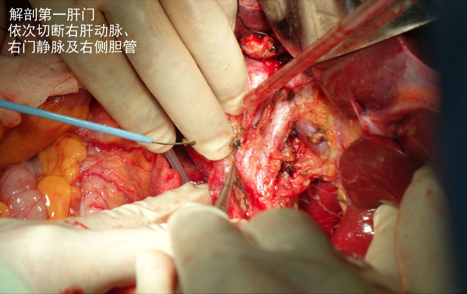 巨大尾状叶肝细胞肝癌切除术1例