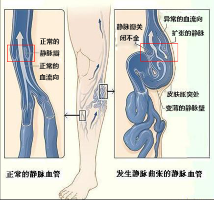 股总静脉瓣膜位置图片图片