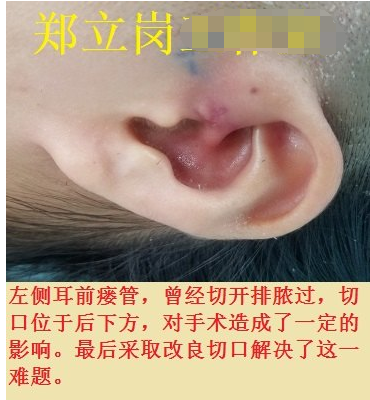 鄭立崗耳前瘻管微創手術第92廣東佛山南海徐