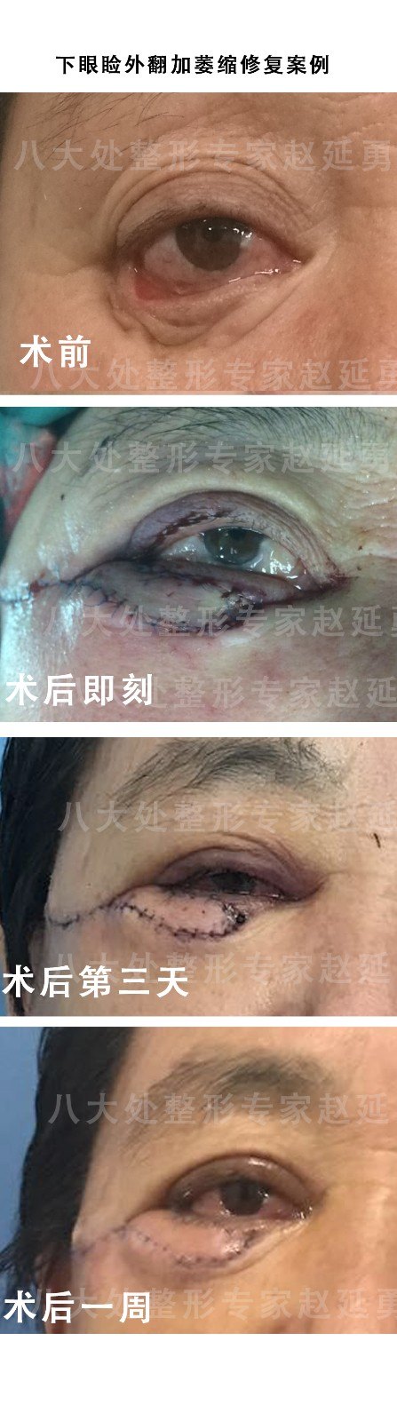 八大处整形专家赵延勇下睑外翻加萎缩修复案例