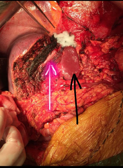 比拳头还大的肿瘤肝左叶巨大肿瘤一例