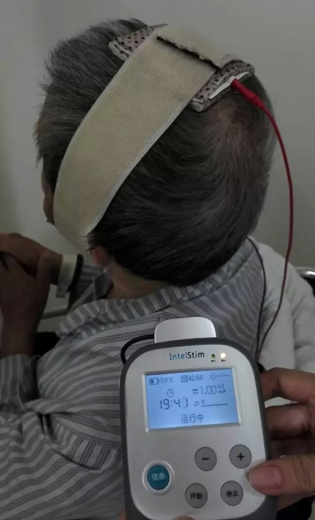 中风的经颅直流电刺激疗法 - 好大夫在线