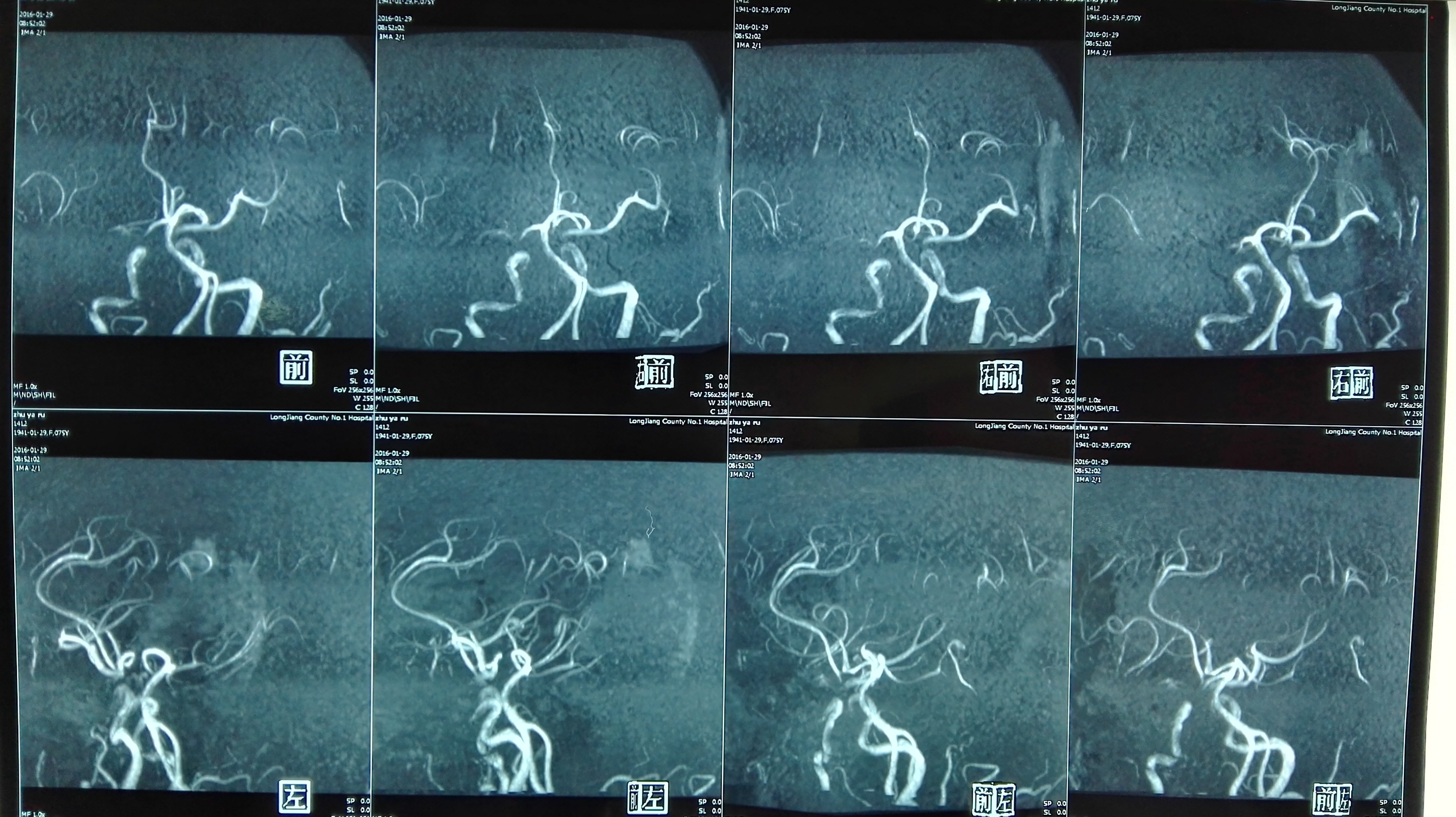 反复多部位脑出血脑淀粉样血管病