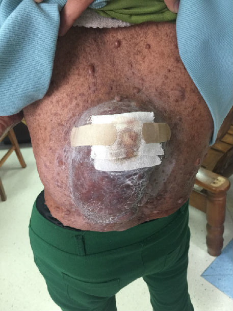 手术治愈困扰患者几十年的背部神经纤维瘤 - 好大夫在线