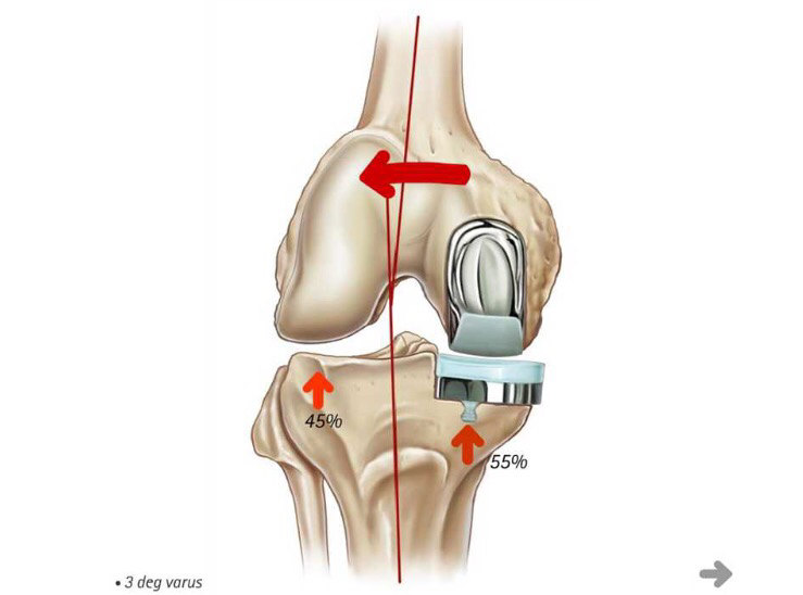 膝关节置换示意图图片