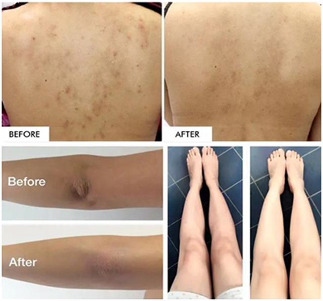 鸡皮肤整容可以去掉吗(鸡皮肤整容可以去掉吗多少钱) 鸡皮肤整容可以去掉吗(鸡皮肤整容可以去掉吗多少钱)