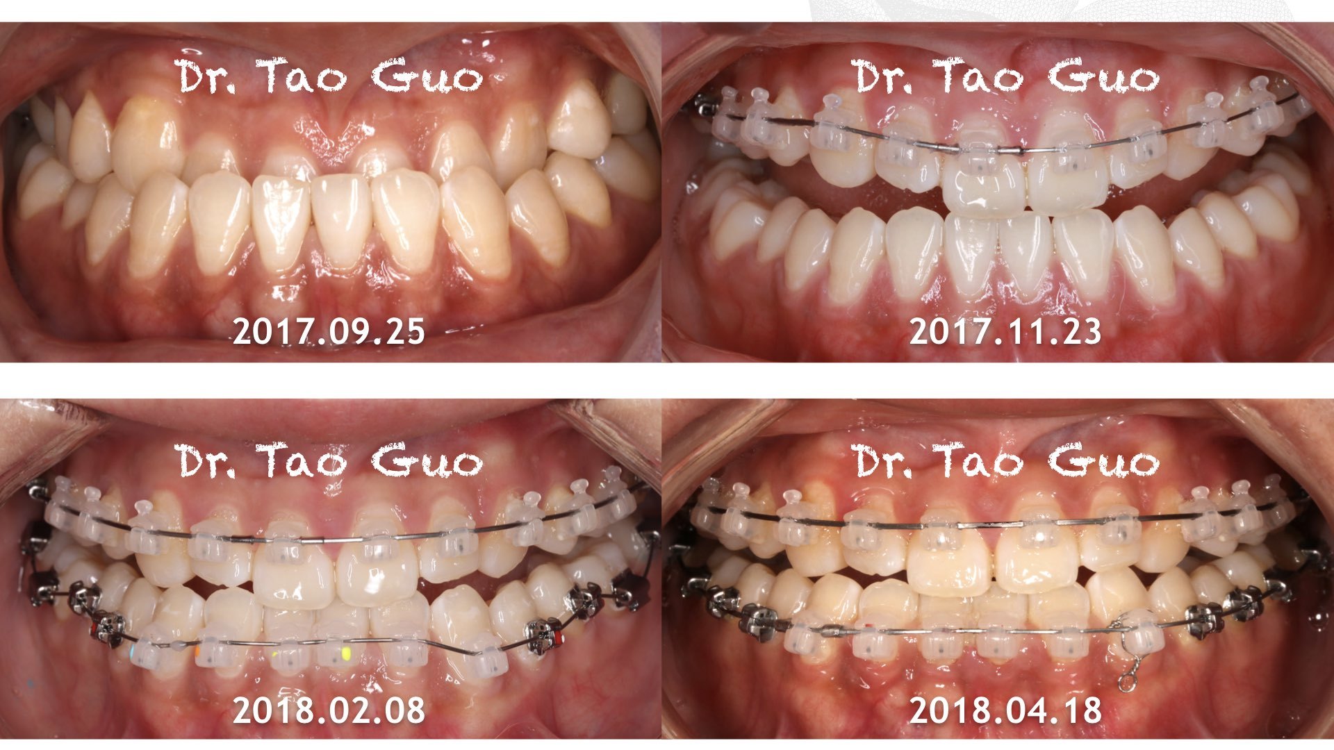 成人地包天矫正案例