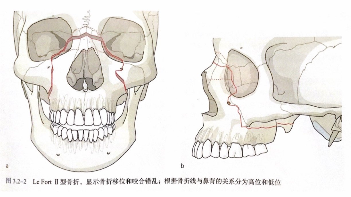 图3 le fort ii型骨折图4.