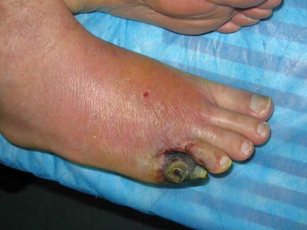 5级:足大部或足全部感染或缺血,导致严重的湿性坏疽或干性坏疽,肢端变