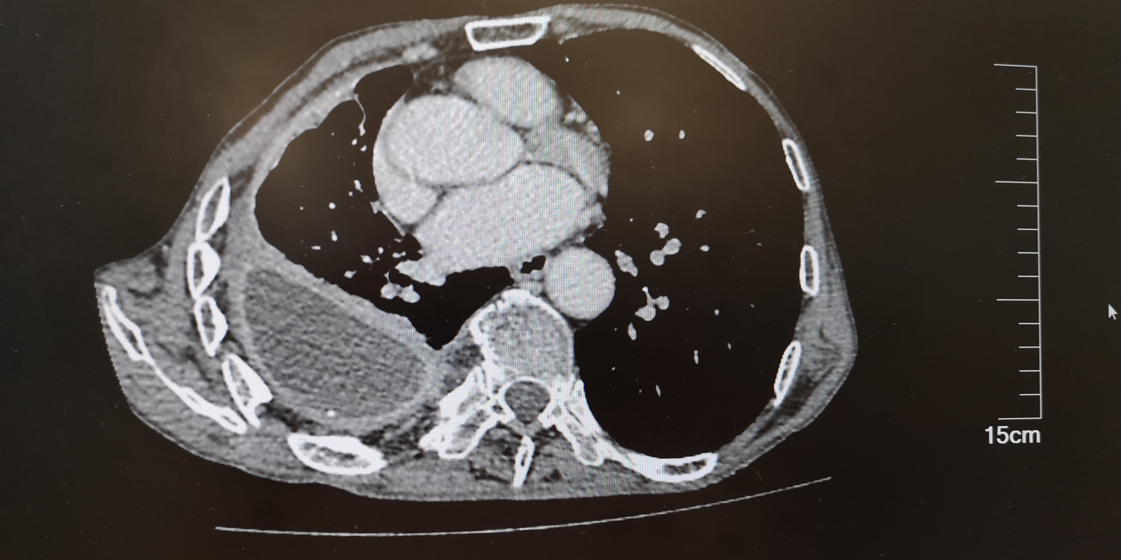 高难度脓胸手术病例分享 - 好大夫在线