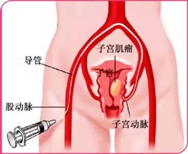 子宫动脉栓塞 Uae 不开刀治疗子宫肌瘤 子宫肌瘤