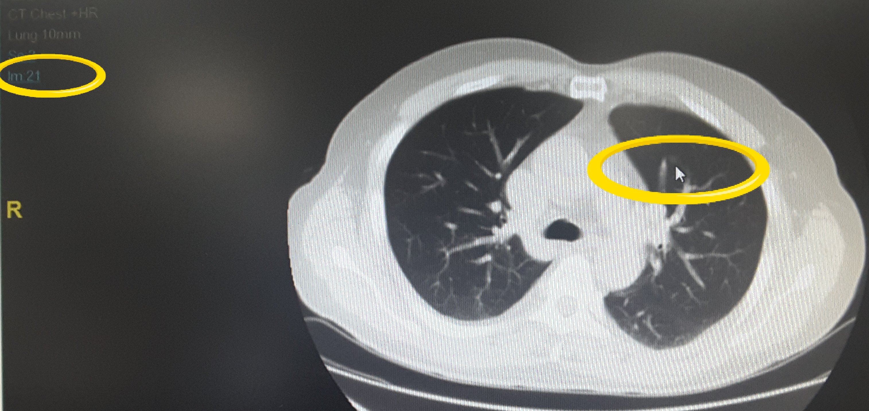 劉懿博士說肺癌七八七肺磨玻璃結節im變化了是結節也變了麼