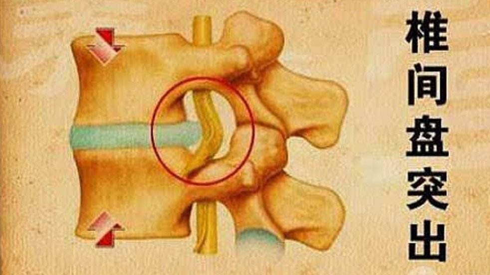 聊聊啥是腰椎间盘突出症病因分型临床表现诊断依据又是啥